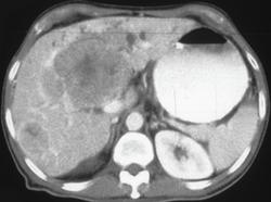 Multifocal Hepatoma - CTisus CT Scan