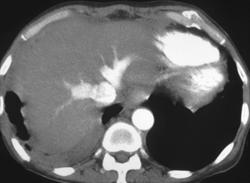 Hepatic Congestion Due to Poor Cardiac Output - CTisus CT Scan