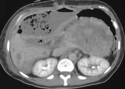 Perihepatic Abscess - CTisus CT Scan