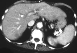 Metastatic Breast Cancer - CTisus CT Scan