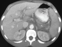 Portal Vein Thrombosis - CTisus CT Scan