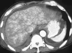 Hepatic Congestion Due to Cardiac Failure - CTisus CT Scan