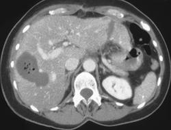 Liver Changes Following Cryosurgery - CTisus CT Scan