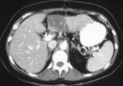 Focal Fatty Liver - CTisus CT Scan