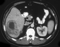 Hepatic Abscess (e. Coli) - CTisus CT Scan