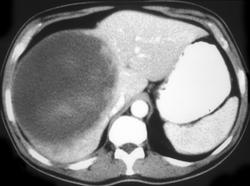 Hepatoma With Spontaneous Intra-tumoral Bleed - CTisus CT Scan