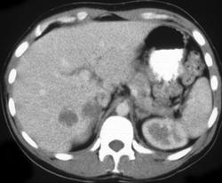 Spontaneous Bleed in A Metastases From Testicular Cancer (left Image Is A Few Months Earlier) - CTisus CT Scan