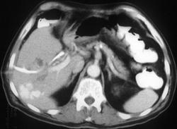 Hepatic Arteriovenous Malformation (AVM) Following Numerous Biliary Stent Placement Attempts - CTisus CT Scan