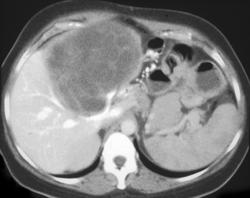 Biliary Cystadenocarcinoma - CTisus CT Scan