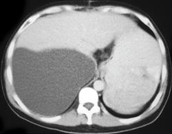 Biloma - CTisus CT Scan