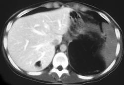 Hepatic Lipoma - CTisus CT Scan