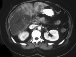 Infarcted Liver. Note Superior Mesenteric Vein (SMV) Thrombus - CTisus CT Scan