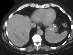 Pseudoaneurysm of the Hepatic Artery - CTisus CT Scan