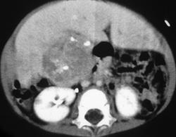 Hepatoblastoma - CTisus CT Scan