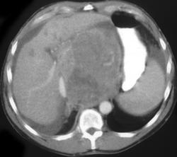 Hepatoma - CTisus CT Scan