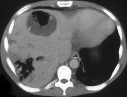 Hepatic Abscess Following Liver Transplant - CTisus CT Scan