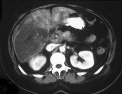 Multiple Hepatic Infarcts - CTisus CT Scan