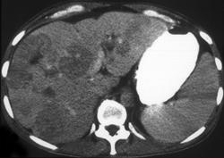 Hepatic Lymphoma - CTisus CT Scan