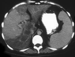 Focal Fat and Liver Metastases - CTisus CT Scan