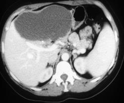 Biliary Cystadenocarcinoma - CTisus CT Scan