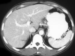 Liver Laceration - CTisus CT Scan