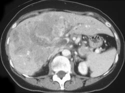 Hepatoma With Portal Vein Thrombosis - CTisus CT Scan