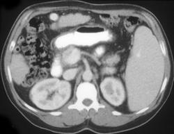 Cirrhosis With Large Umbilical Vein - CTisus CT Scan