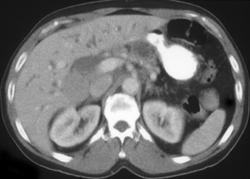 Cholangiocarcinoma - CTisus CT Scan