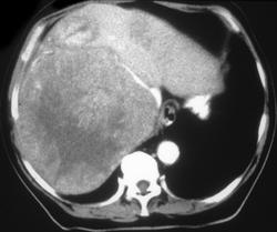 Hepatoma - CTisus CT Scan