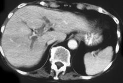 Liver Laceration - CTisus CT Scan