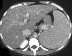 Mai Liver - CTisus CT Scan