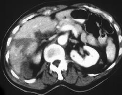 Hepatic Laceration - CTisus CT Scan