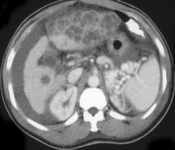 Hepatoma - CTisus CT Scan