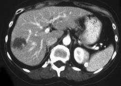 Hepatic Hemangioma - CTisus CT Scan