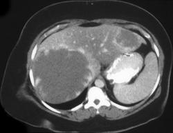 Hemangioma - CTisus CT Scan