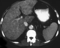 Hepatitis - CTisus CT Scan