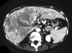 Hepatoma Invades Portal Vein - CTisus CT Scan