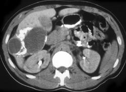 Hydatid Liver Disease - CTisus CT Scan