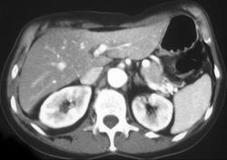 Radiation Changes in the Liver - CTisus CT Scan