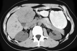 Focal Nodular Hyperplasia - CTisus CT Scan