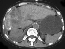 Bleed in Liver Following Cryosurgery - CTisus CT Scan