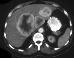 Hemangiopericytoma of the Liver - CTisus CT Scan