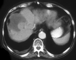 Hepatoma With Metastases to the Sacrum - CTisus CT Scan