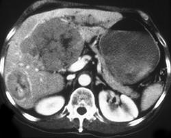 Hepatoma - CTisus CT Scan