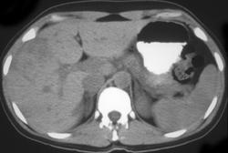 Focal Nodular Hyperplasia - CTisus CT Scan