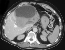 Biliary Cystadenocarcinoma - CTisus CT Scan