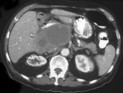 Hepatoma Simulates A Hepatic Abscess - CTisus CT Scan