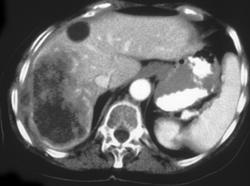 Cholangiocarcinoma - CTisus CT Scan