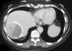 Hydatid Disease - CTisus CT Scan