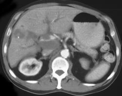 Cholangiocarcinoma in A Patient With Sclerosing Cholangitis - CTisus CT Scan